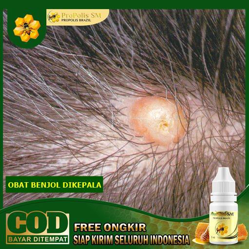 Jual Obat Benjolan Di Kepala Benjolan Di Leher Kelenjar Getah Bening