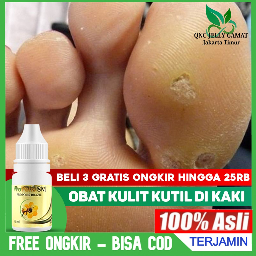 Jual Obat Kulit Kutil Di Kaki Penghilang Mata Ikan Perontok Kutil