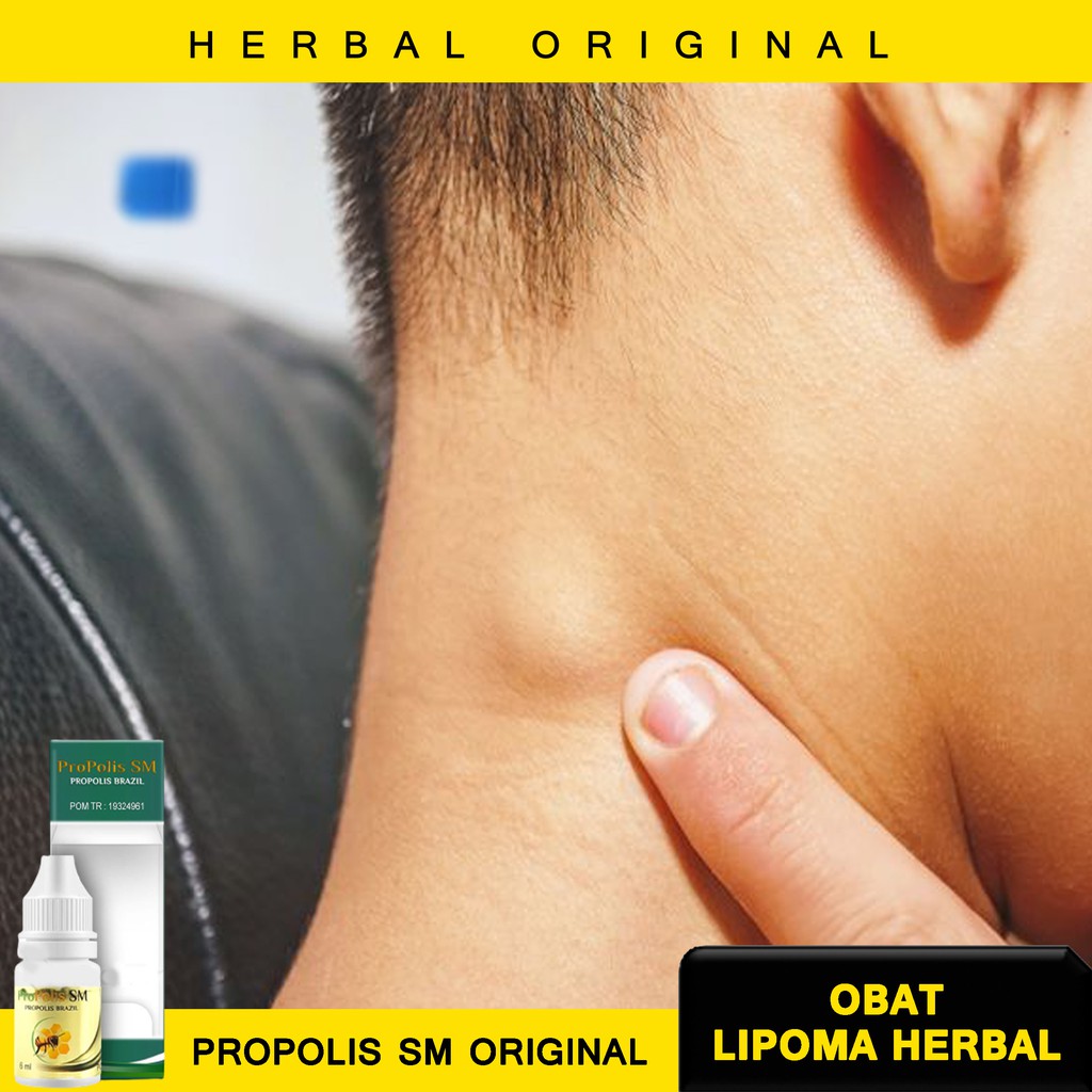 Jual Obat Benjolan Tidak Normal Uci Uci Benjolan Leher Benjolan