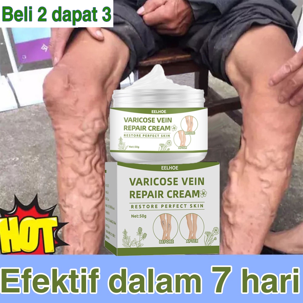 Jual Obat Varises Salep Varises Cream Varicose Veins Varikokel Bengkak