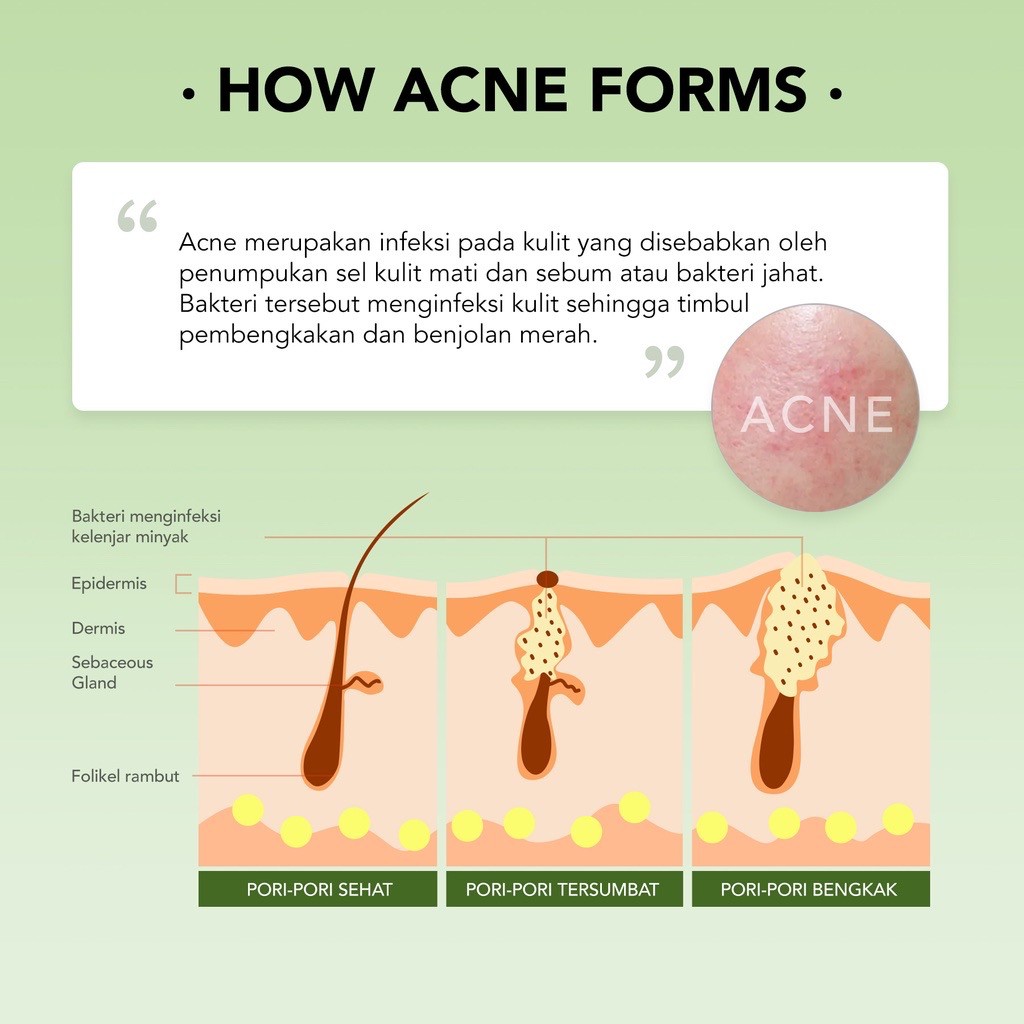 Jual YOU Acne Plus Triple Action SPOT CARE Spot Acne Obat Jerawat