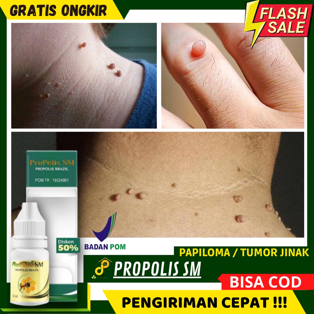 Jual Pengobatann Herbal Hilangkan Papiloma Atau Daging Tumbuh Kecil