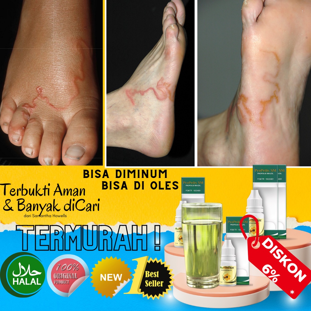 Jual Obat Cutaneous Larva Migrans Penghilang Cacing Pasir Cacing