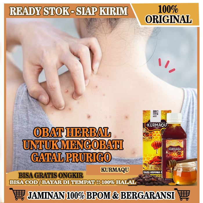 Jual Obat Alami Gatal Prurigo Obat Alami Darah Manis Peradangan Ruam