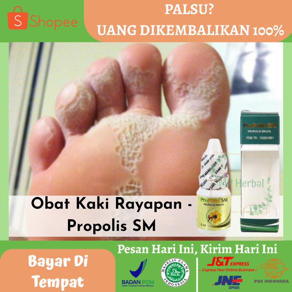 Jual Obat Kaki Rayapan Obat Telapak Kaki Rayapan Obat Rangen Kaki