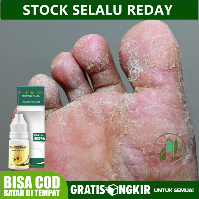 Jual Obat Kutu Air Obat Kutu Air Pada Telapak Kaki Jamur Kaki Gatal