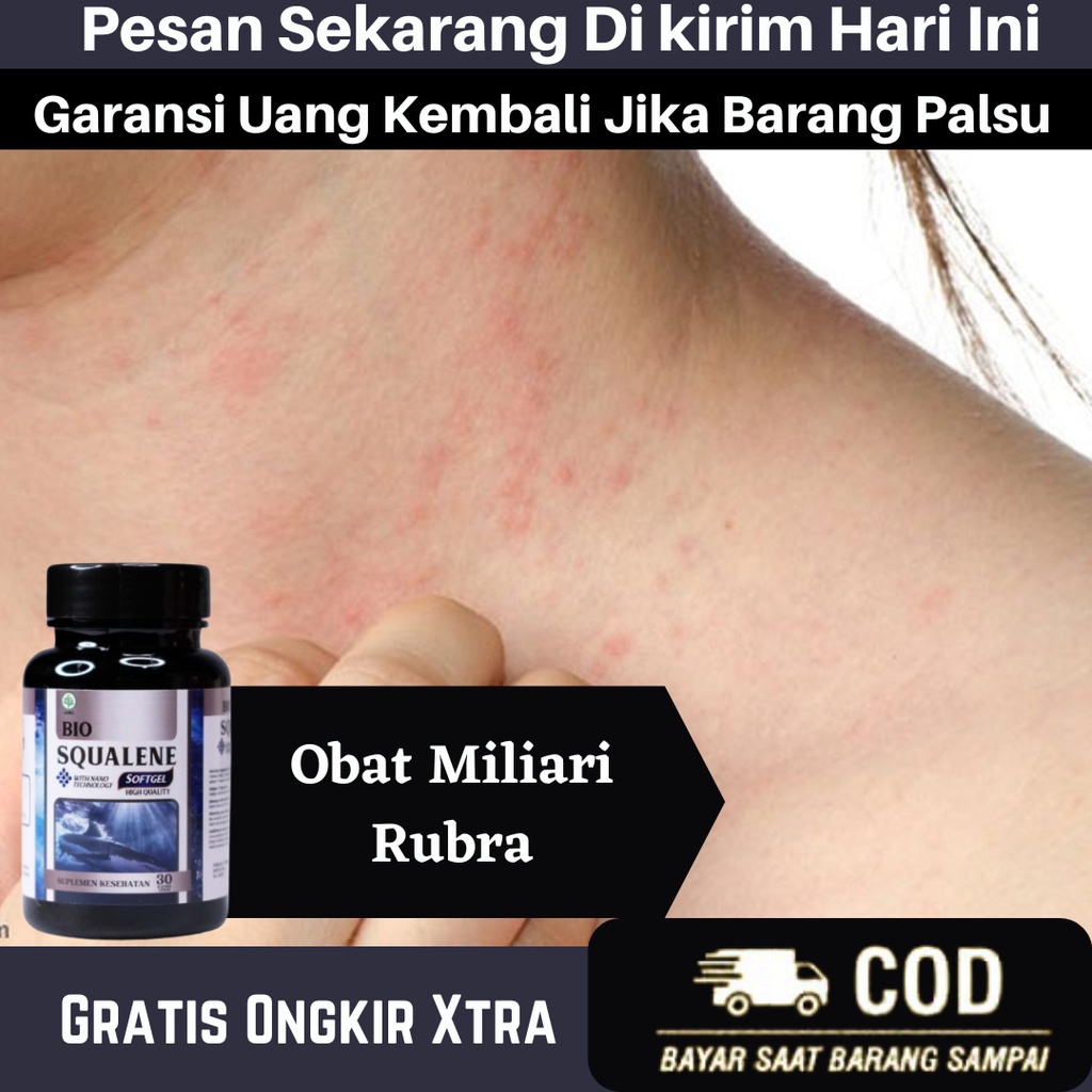 Jual Obat Miliari Rubra Obat Gatal Biang Keringat Obat Gatal Gatal