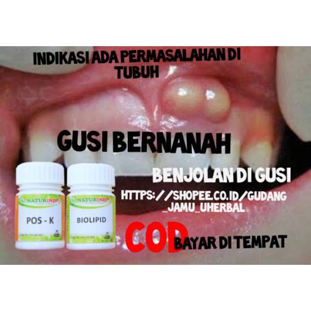 Jual Obat Herbal Sakit Gigi Gusi Bengkak Gusi Bernanah Shopee Indonesia