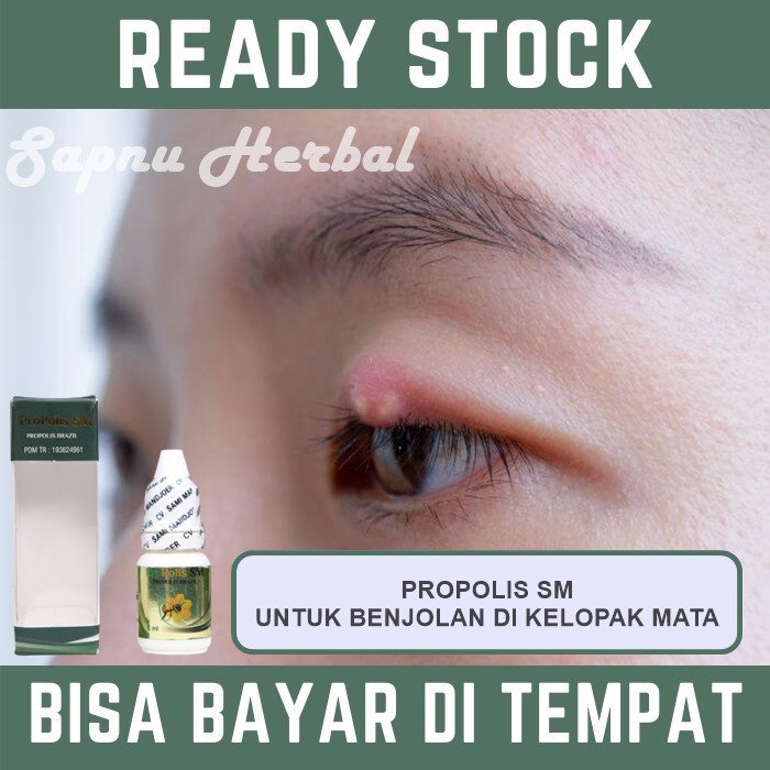 Jual Obat Oles Penghilang Benjolan Di Kelopak Mata Kalazion Mata