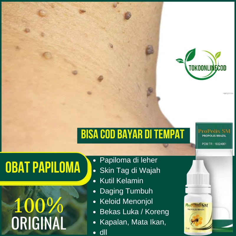 Jual Obat Papiloma Tradisional Penghilang Skin Tag Di Leher Daging