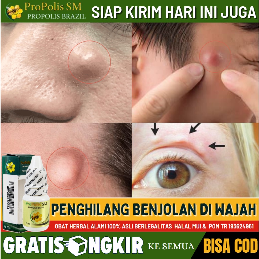 Jual Obat Alami Penghilang Benjolan Abnormal Di Wajah Original