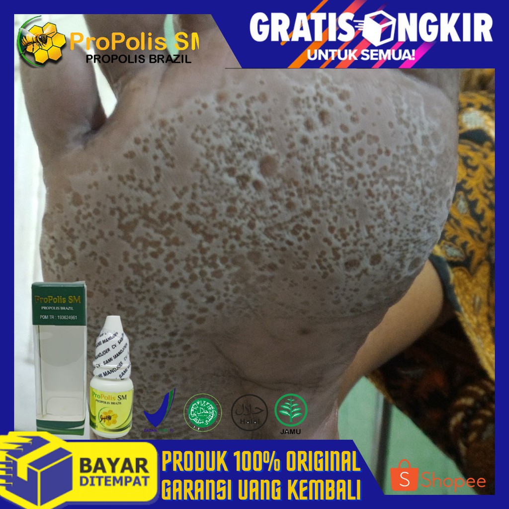 Jual Propolis SM Spesialis Obat Telapak Kaki Rayapan Telapak Kaki