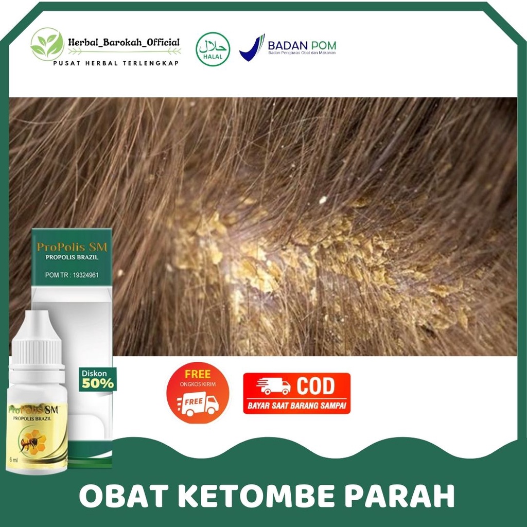 Jual Obat Ketombe Parah Di Kepala Kulit Kepala Kering Pecah Pecah