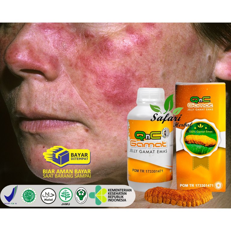 Jual Obat Lupus Gatal Alergi Kulit Eksim Scabies Psoriasis Dermatitis