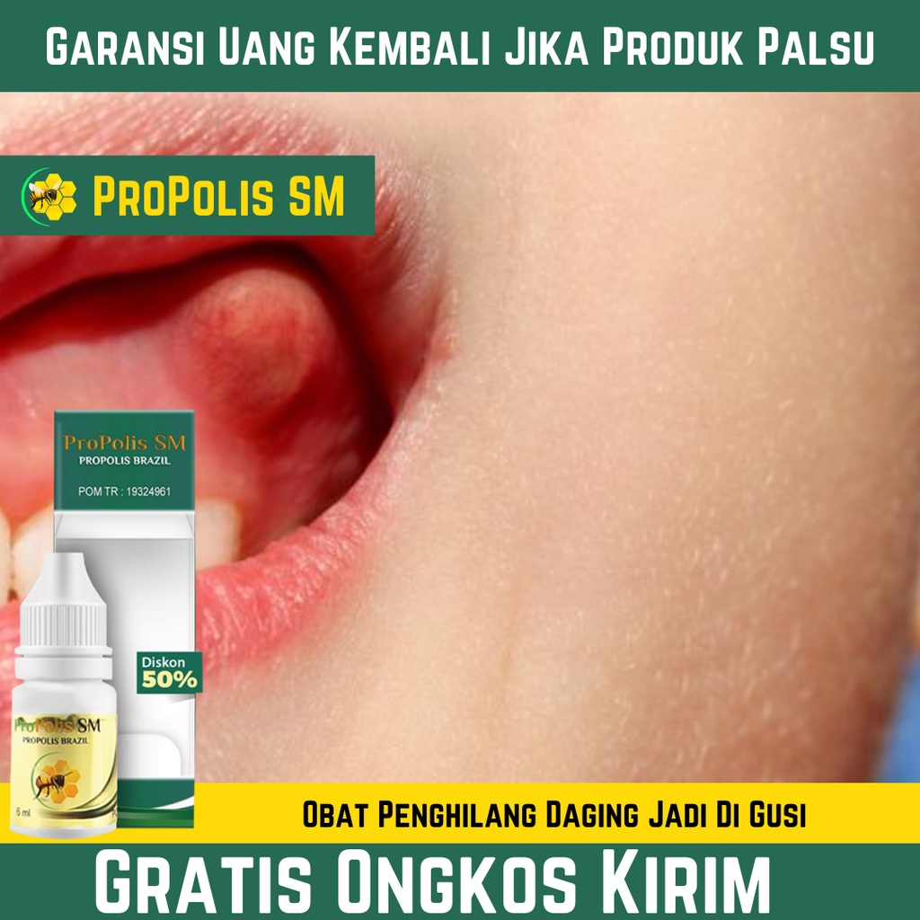 Jual Obat Penghilang Daging Jadi Di Gusi Polip Pulpa Pengecil Gusi