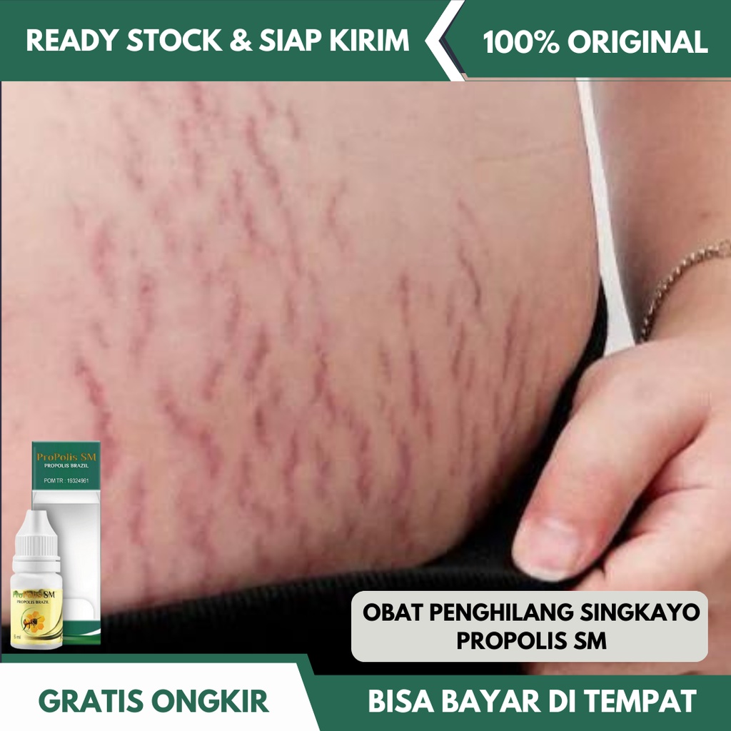 Jual Obat Singkayo Penghilang Singkayo Stretchmark Penghilang