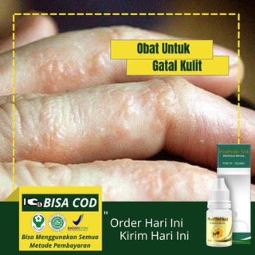 Jual Obat Gatal Berair Kulit Melepuh Eksim Eksem Penyakit Kulit