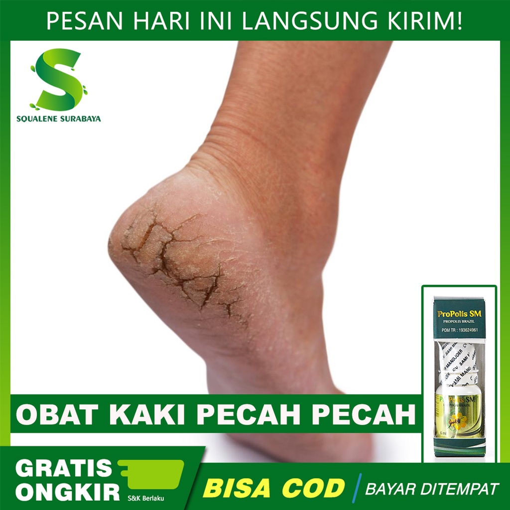 Jual Obat Kaki Pecah Pecah Telapak Kaki Rayapan Kaki Pecah Pecah