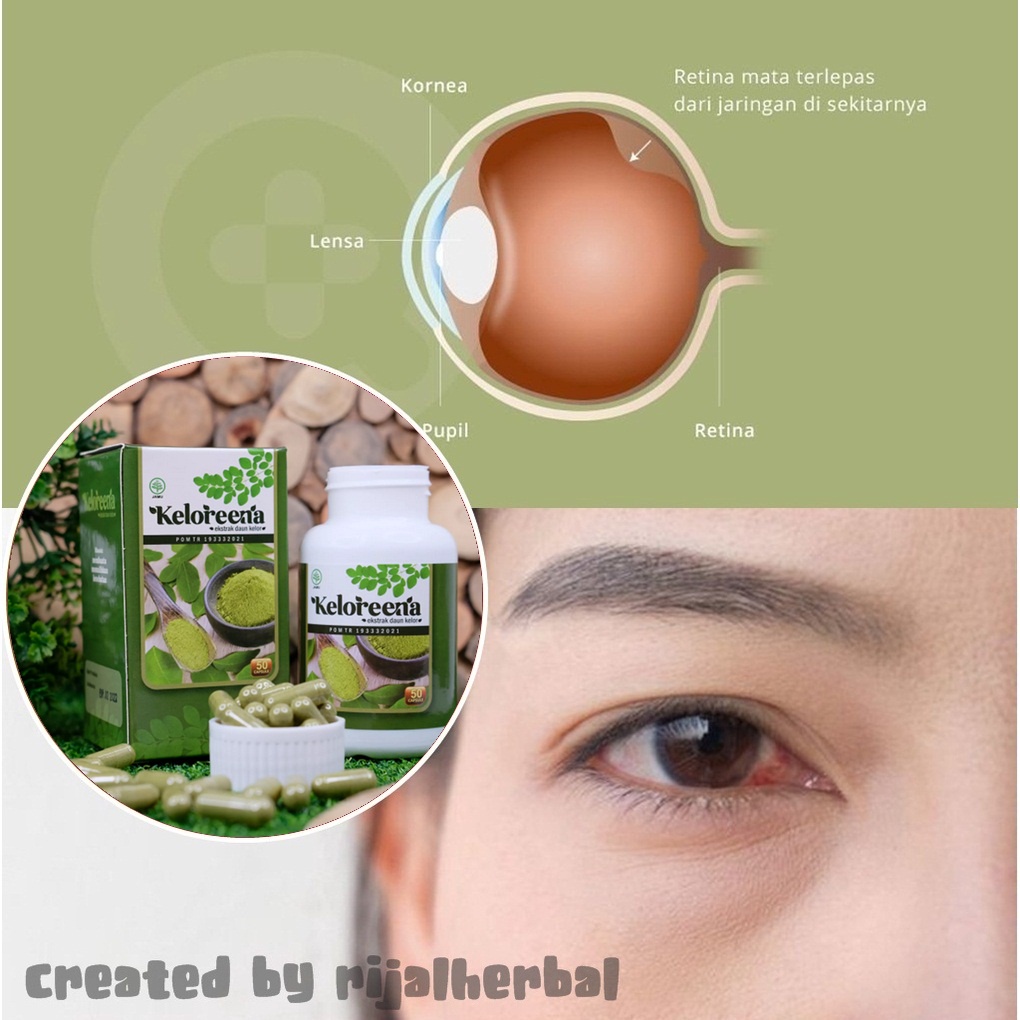 Jual Obat Ablasio Retina Obat Ablasi Retina Obat Retina Lepas Obat