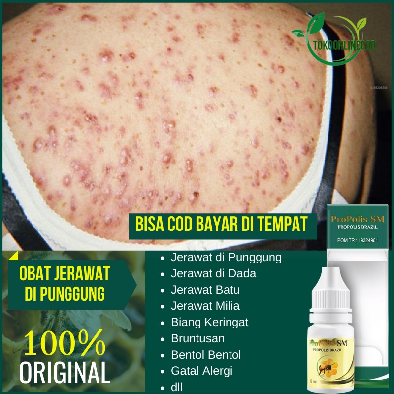 Jual Obat Jerawat Punggung Dada Badan Bokong Pantat Bruntusan Biang