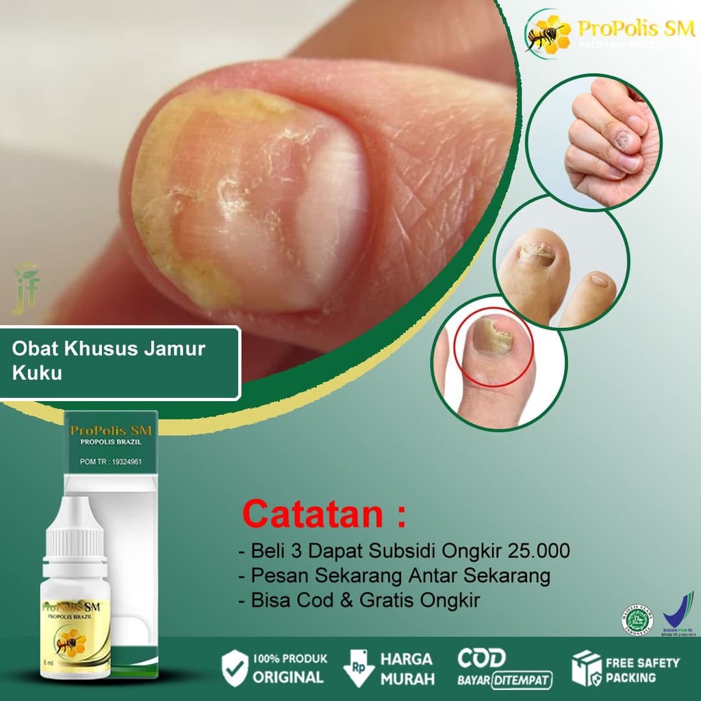 Jual Obat Jamur Kuku Kaki Rayapan Psoriasis Pecah Pecah Kutu Air