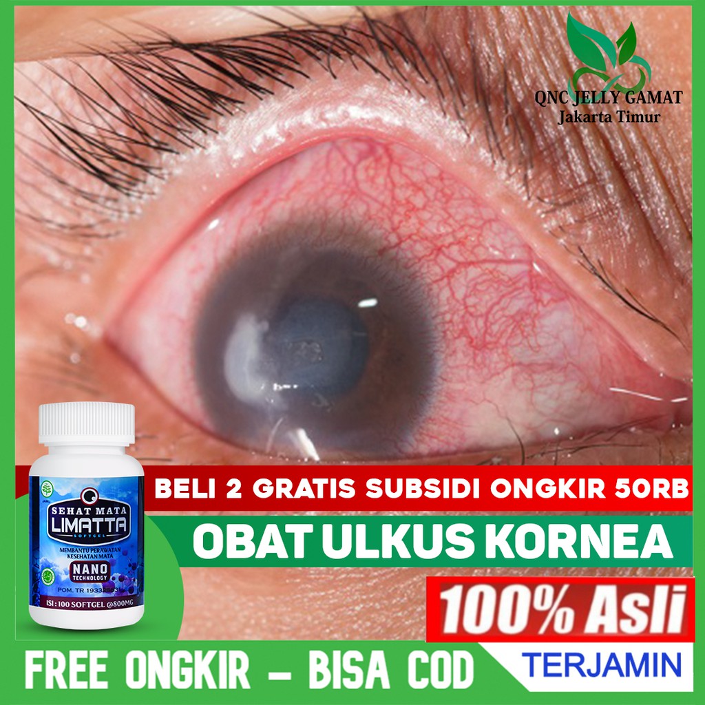 Jual Obat Ulkus Kornea Infeksi Luka Pada Mata Pterigium Pterygium