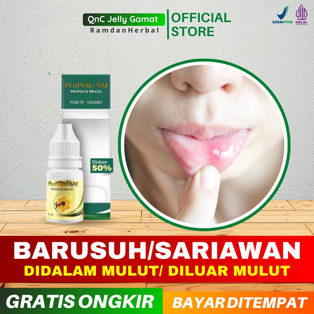 Jual Obat Barusuh Sariawan Stomatitis Aphtosa Sariawan Di Bibir Di