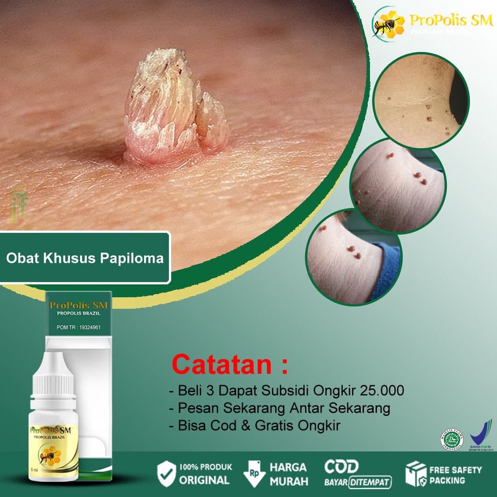 Jual Obat Herbal Papiloma HPV Kutil Di Kulit Kelamin Daging Tumbuh