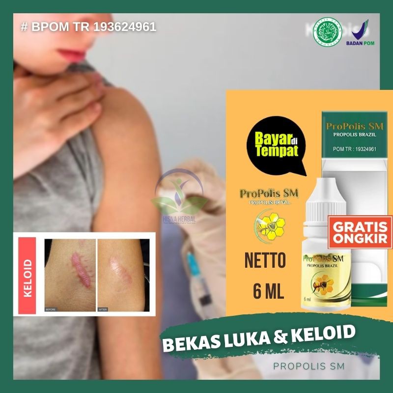 Jual Obat Tetes Penghilang Keloid Bekas Luka Caesar Operasi Eksim