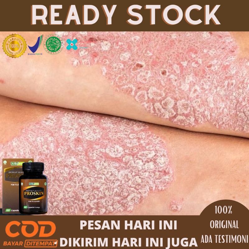 Jual Obat Gatal Kulit Psoriasis Obat Psoriasis Menahun Kulit Bersisik