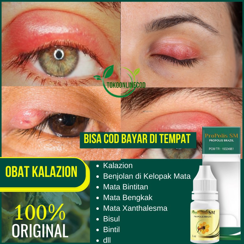 Jual Obat Benjolan Di Kelopak Mata Kalazion Mata Bengkak Mata Bintit