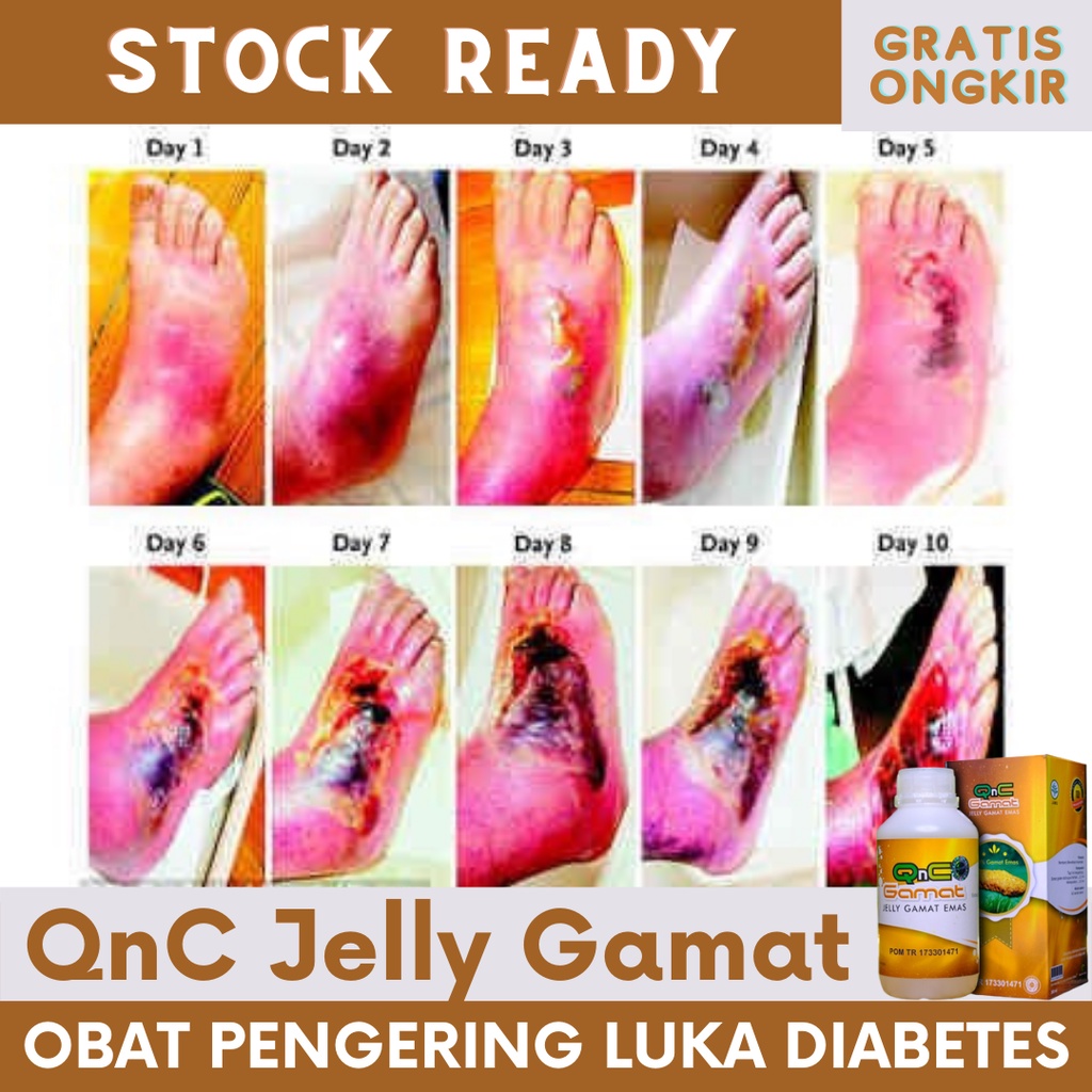 Jual Obat Luka Diabetes Melitus Luka Diabetes Bernanah Luka Diabetes