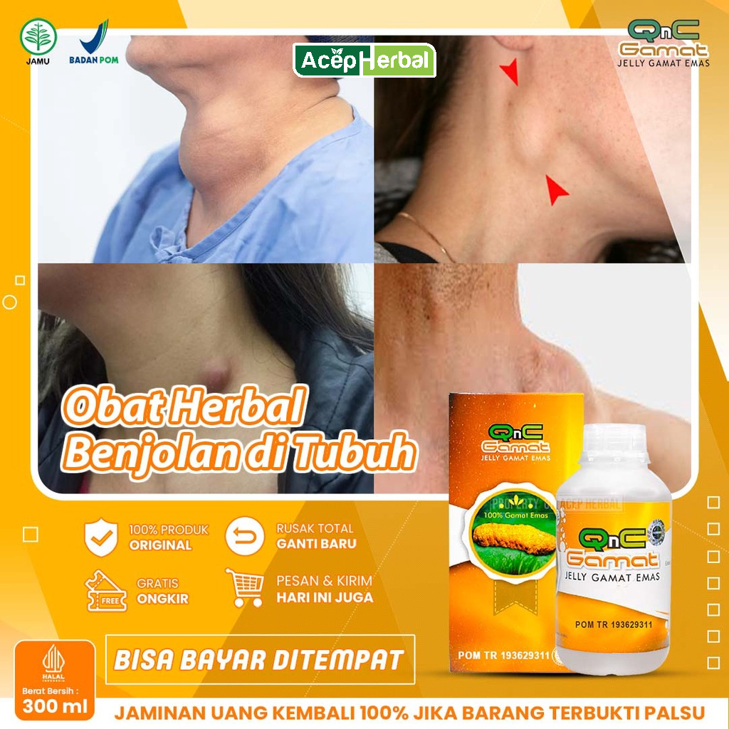 Jual Obat Benjolan Di Leher Kelenjar Getah Bening Lipoma Uci Uci