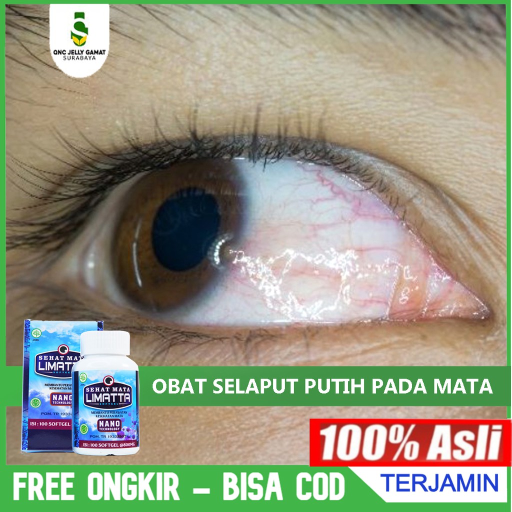 Jual Obat Herbal Selaput Putih Pada Mata Lamad Mata Pterygium Sehat