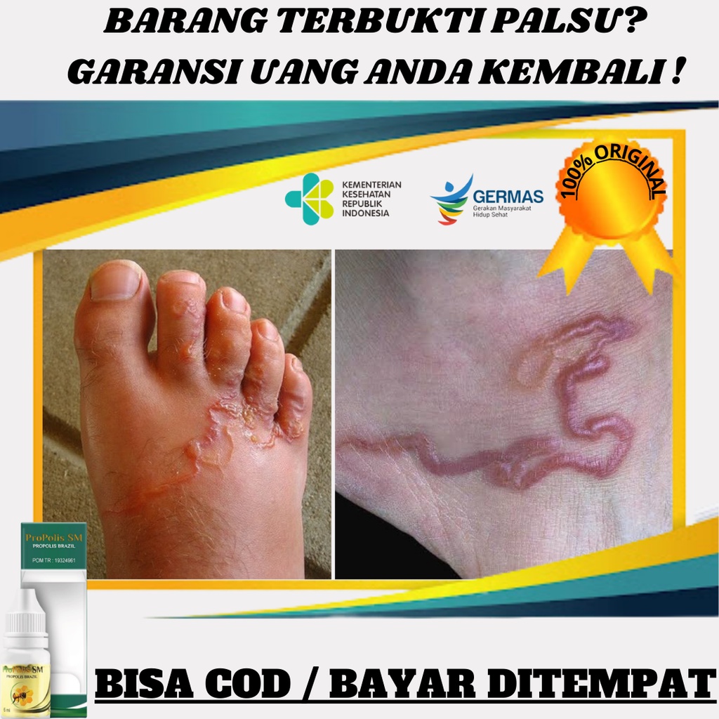 Jual Obat Tetes Penghilang Cacing Pasir Obat Cutaneous Larva Migrans