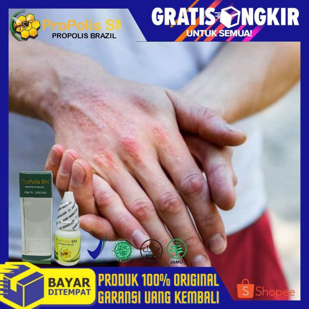 Jual COD Obat Penyakit Eksim Basah Eksim Kering Dermatitis Atopik