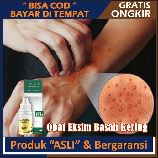 Jual Obat Eksim Basah Menahun Infeksi Kulit Gatal Exsim Jamur Gatel