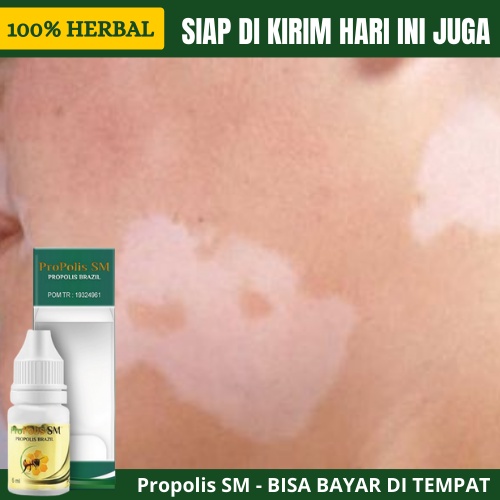 Jual Obat Bercak Putih Pada Kulit Seperti Panu Bercak Putih Di Wajah