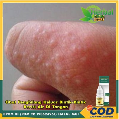 Jual Obat Penghilang Keluar Bintik Bintik Berisi Air Di Tangan Obat