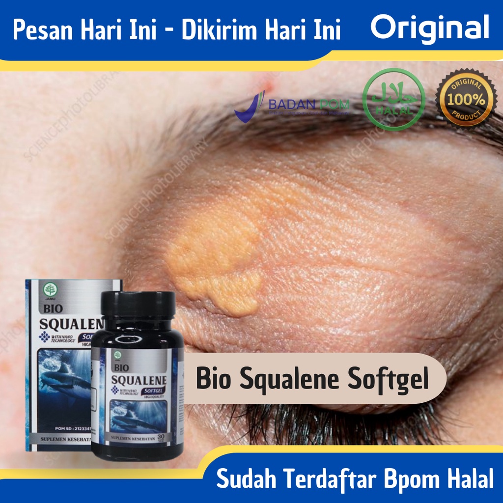 Jual Bio Squalene Softgel Obat Penghilang Plak Kuning Di Kelopak Mata