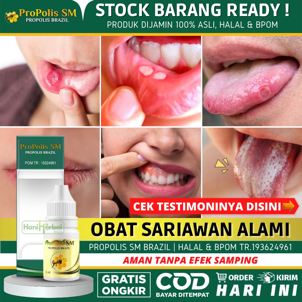 Jual Obat Sariawan Yang Asli Alami Sariawan Menahun Sariawan Di