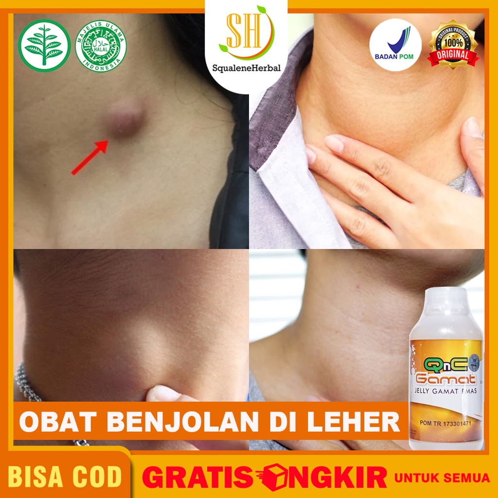 Jual Obat Benjolan Di Leher Kelenjar Getah Bening Obat Benjolan