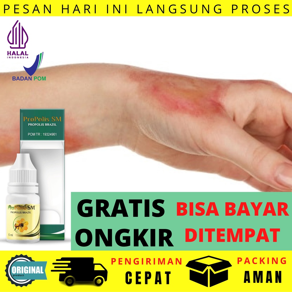 Jual Obat Luka Bakar Bernanah Diabetes Luka Jatuh Lecet Luka