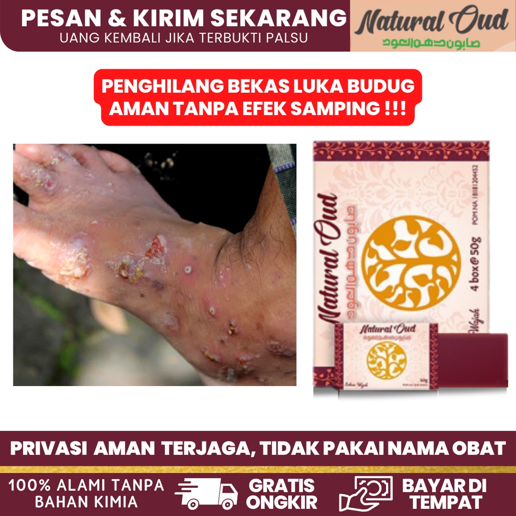 Jual Sabun Obat Budug Di Kaki Obat Budug Obat Gudik Gudig Obat