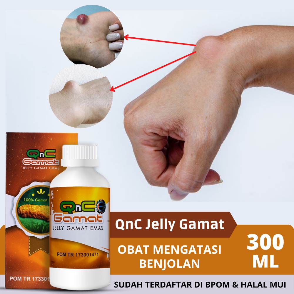 Jual Solusi Obat Kista Ganglion Benjolan Di Tangan Tumor Tendon