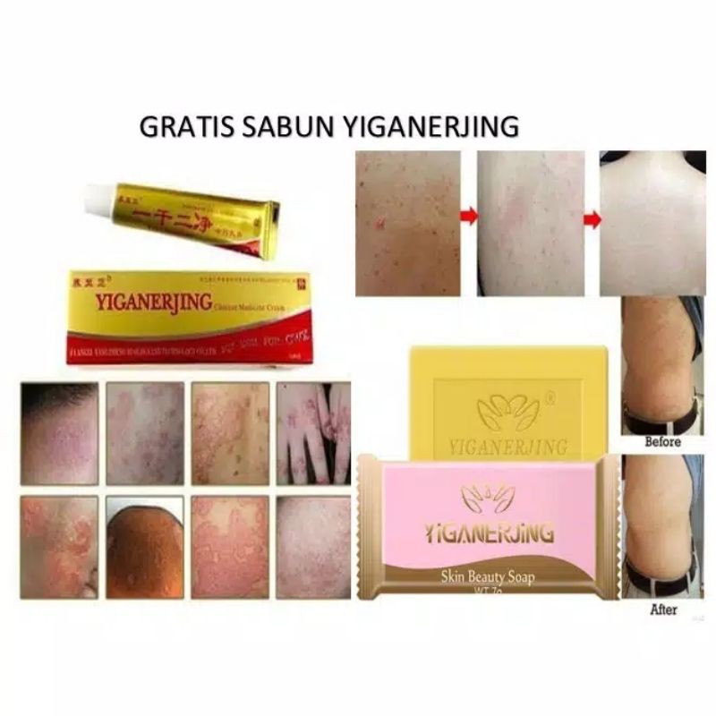 Jual Paket Salep Sabun Yiganerjing Obat Salep Gatal Gatel Kurap Jamur