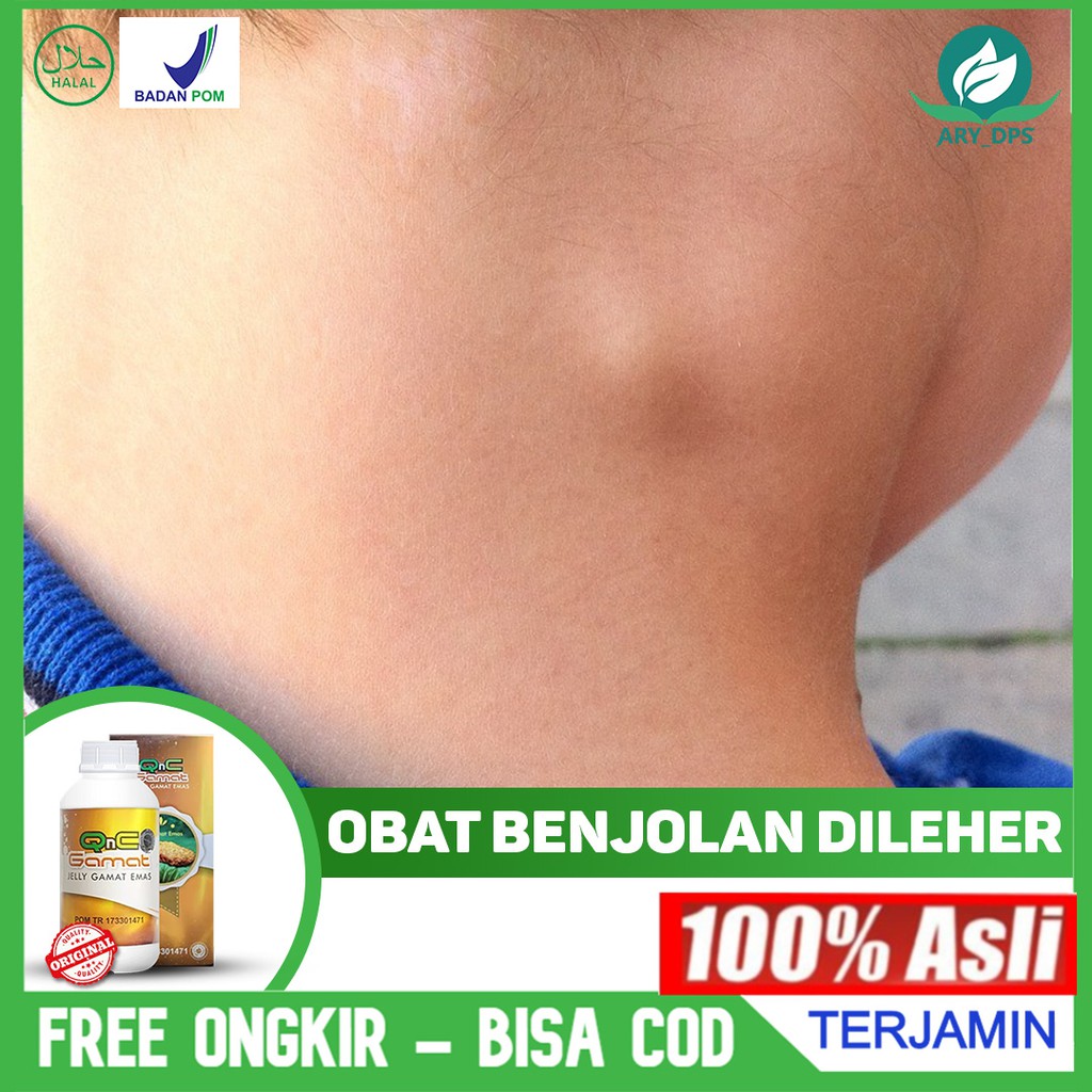 Jual Obat Benjolan Di Leher Gondok Lipoma Kelenjar Getah Bening