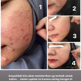 Jual SCARLET WHITENING GLOWTENING SERUM ACNE BRIGHTLY EVER After