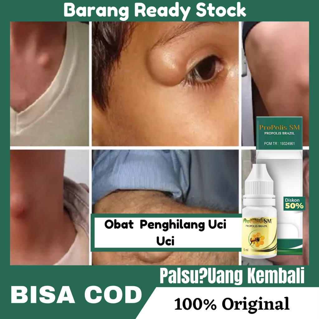 Jual Obat Penghilang Uci Uci Di Tangan Wajah Benjolan Lipoma Di