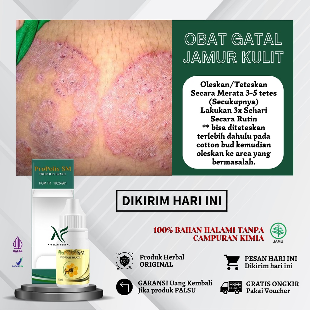 Jual Obat Dermatitis Atopik Seboroik Neurodermatitis Obat Eksim Basah